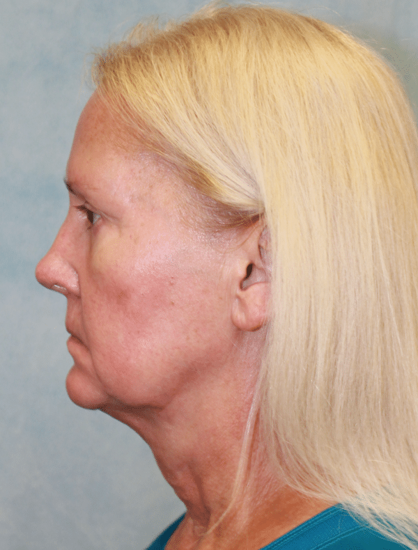 Facelift