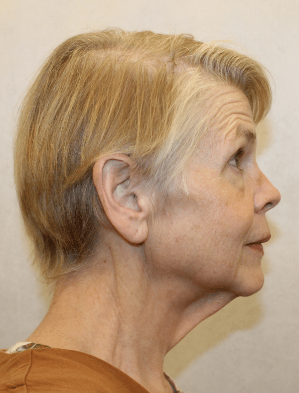 Facelift