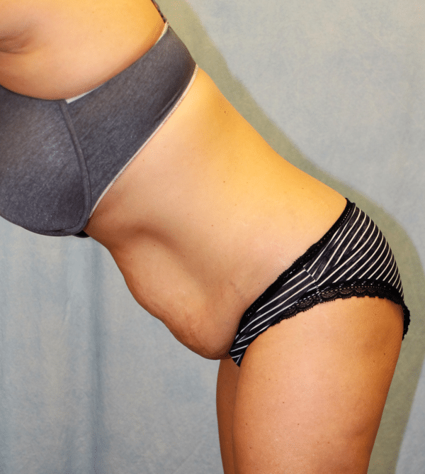 Abdominoplasty - Tummy Tuck