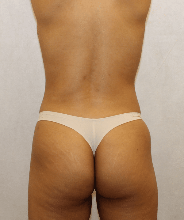 Liposuction
