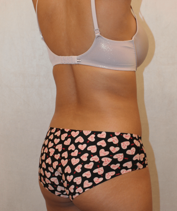 Liposuction