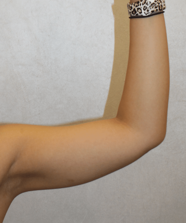 Liposuction