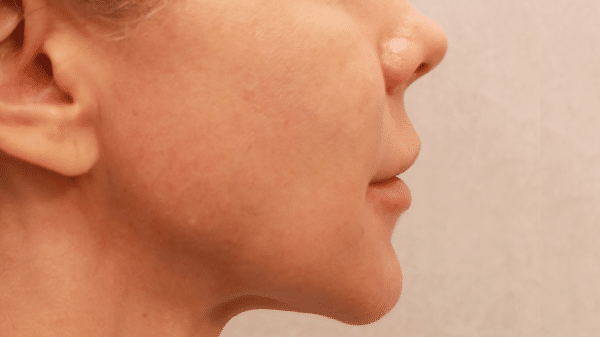 Face Procedures