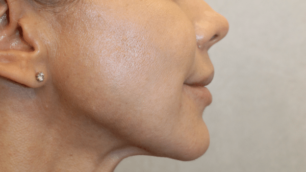 Face Procedures