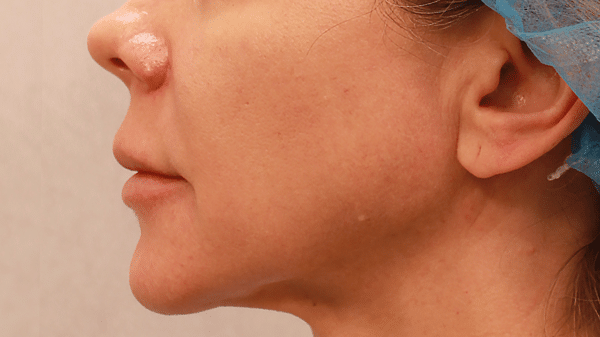 Face Procedures