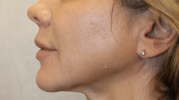 Face Procedures