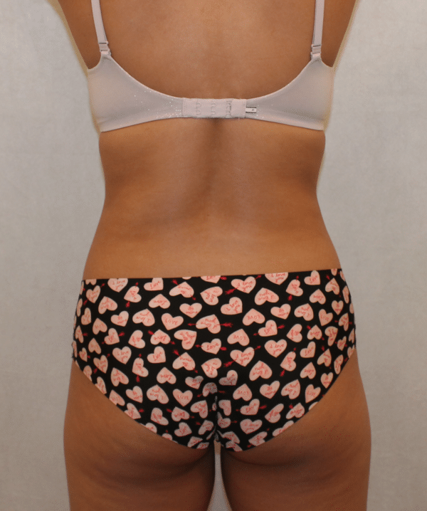 Liposuction