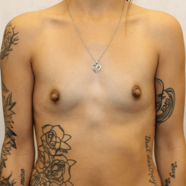 Breast Augmentation