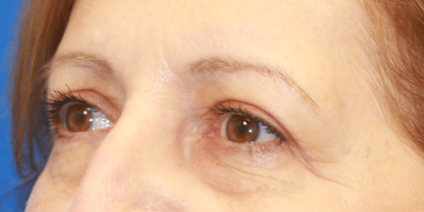 Eye Lift (Blepharoplasty)
