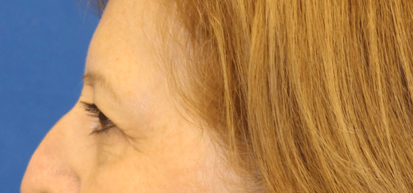 Eye Lift (Blepharoplasty)