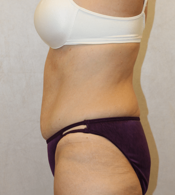 Body Procedures