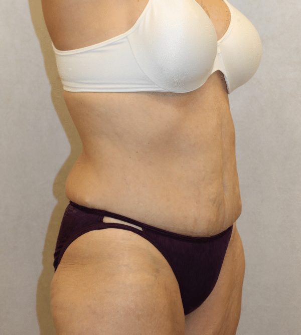 Body Procedures