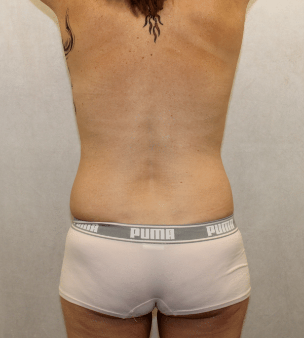 Breast Lift with Implants