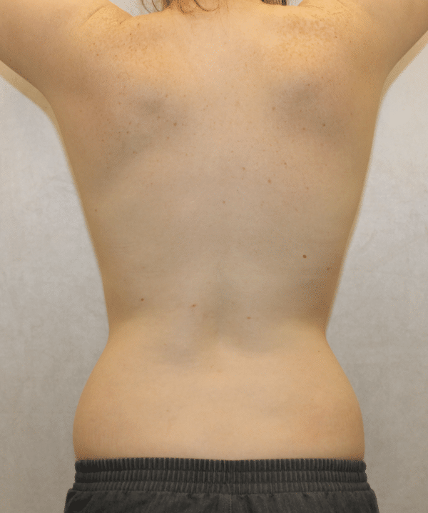 Breast Augmentation