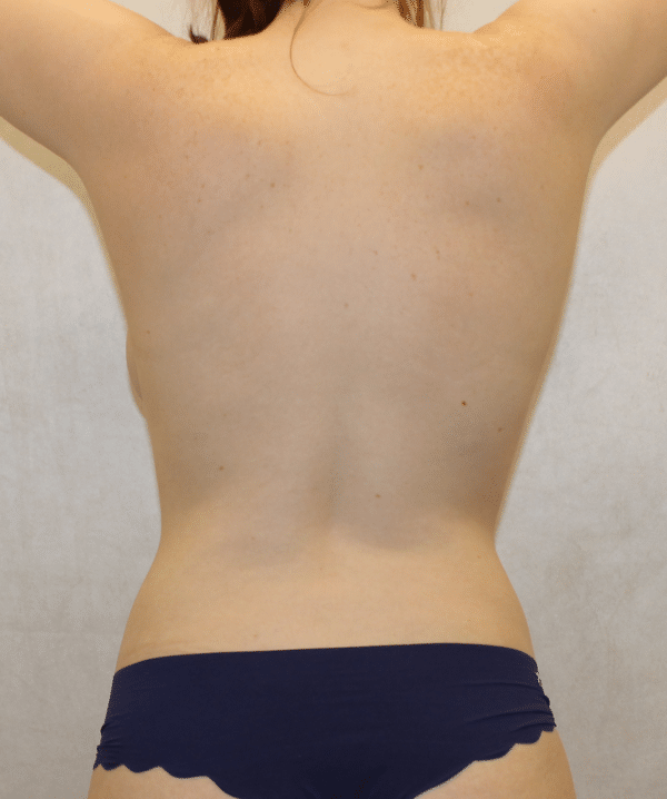 Breast Augmentation