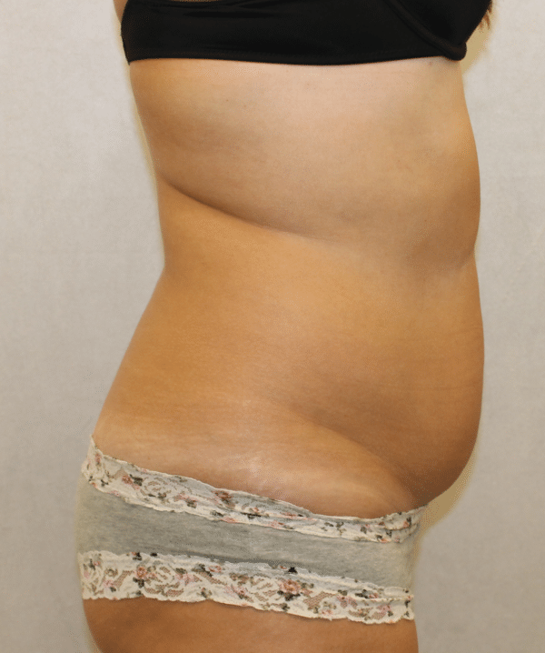 Liposuction