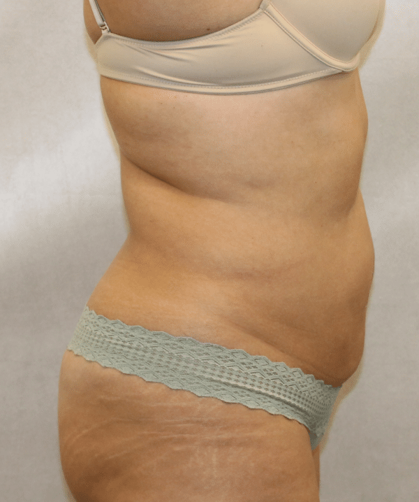 Liposuction