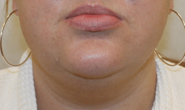 Liposuction
