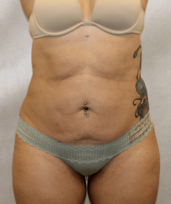 Liposuction