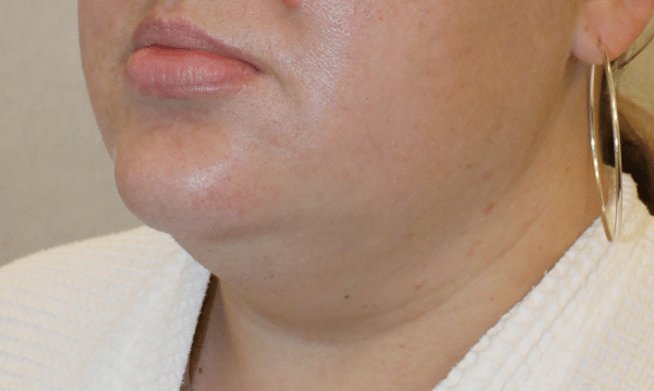 Liposuction