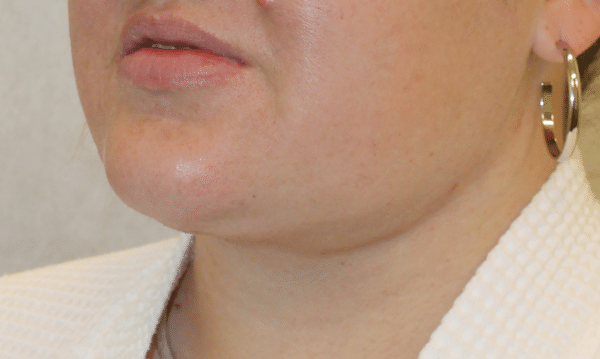 Liposuction