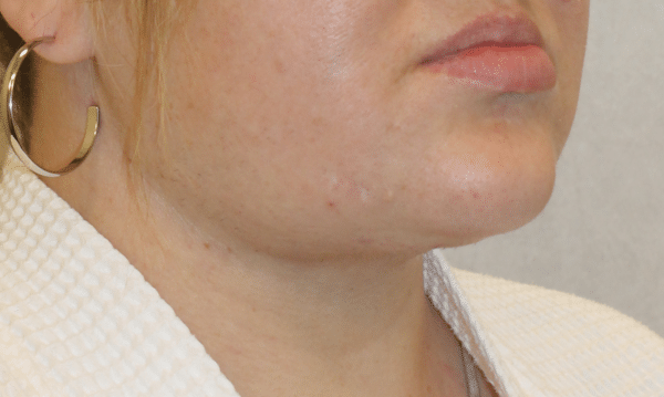 Liposuction