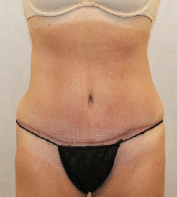 Body Procedures