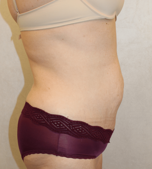 Body Procedures