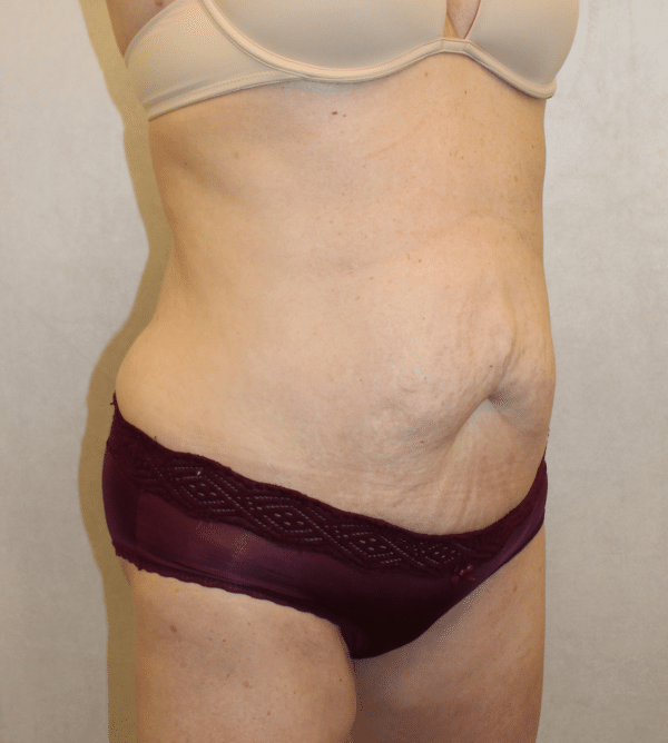 Body Procedures