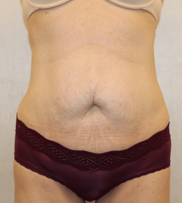 Body Procedures