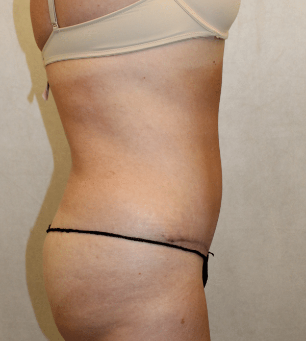 Body Procedures
