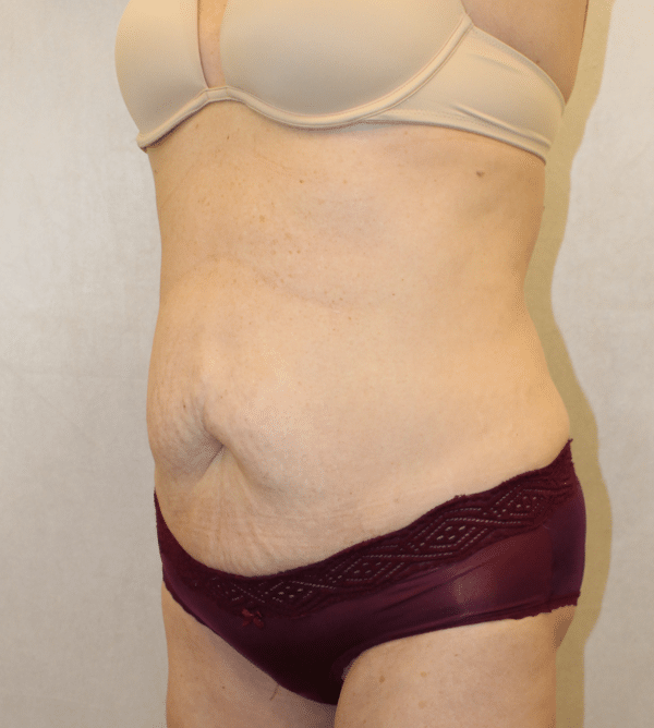 Body Procedures