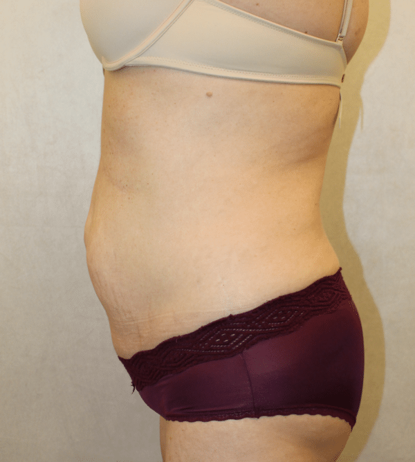 Body Procedures