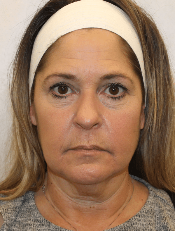 Facelift