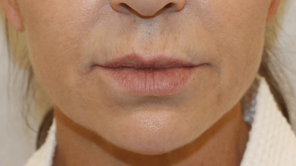 Face Procedures