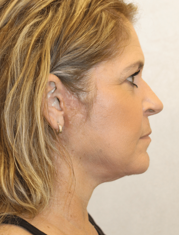 Facelift