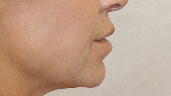 Face Procedures