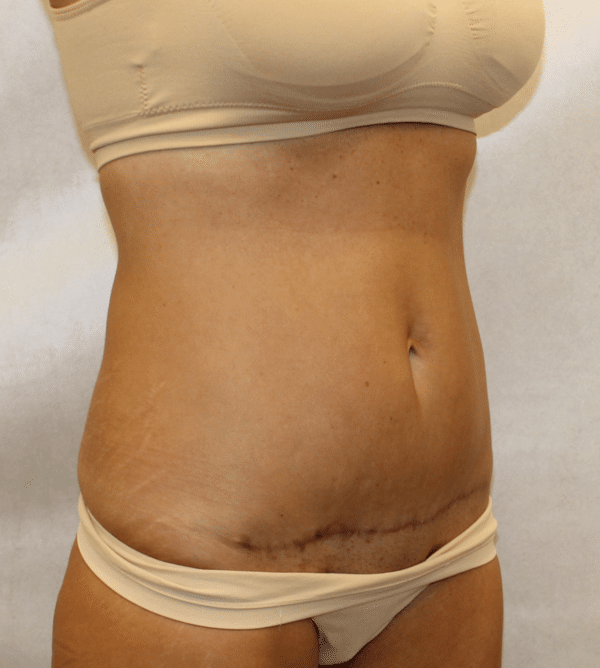 Body Procedures