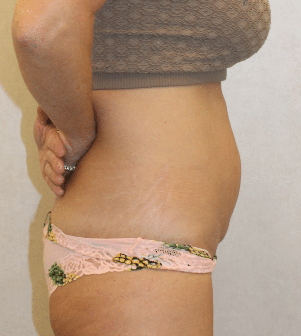 Body Procedures
