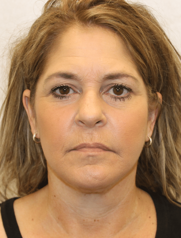 Facelift