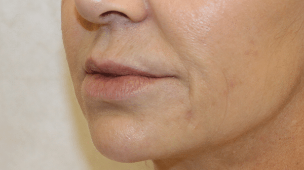 Face Procedures