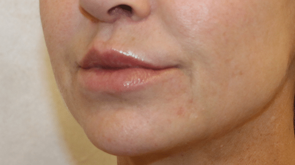 Face Procedures
