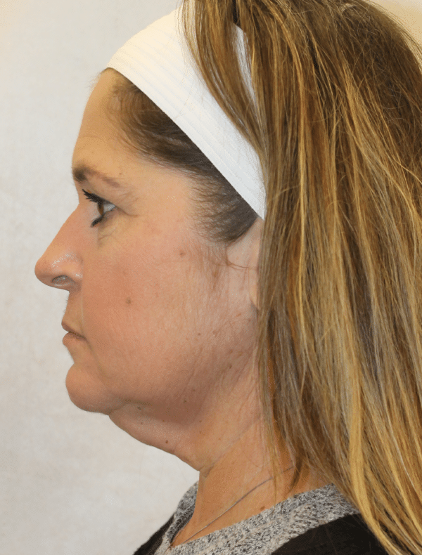 Facelift