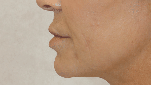 Face Procedures