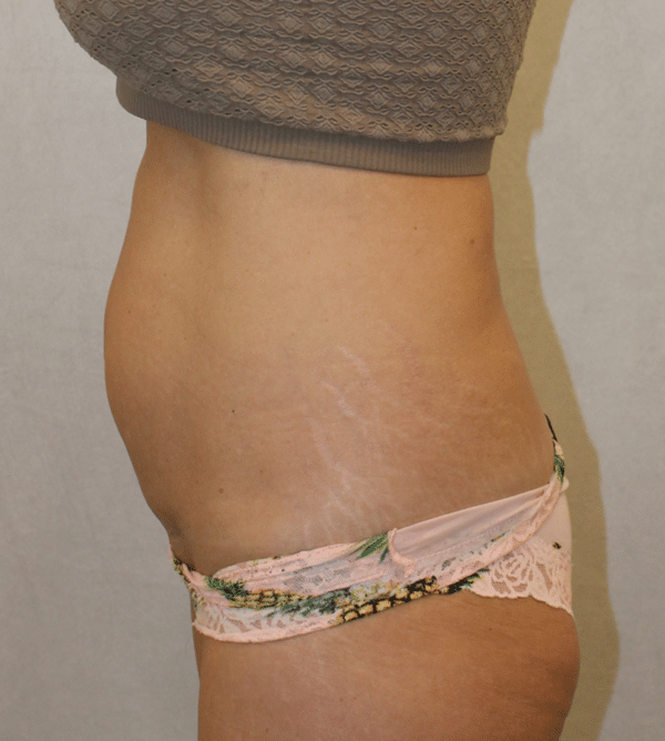Body Procedures