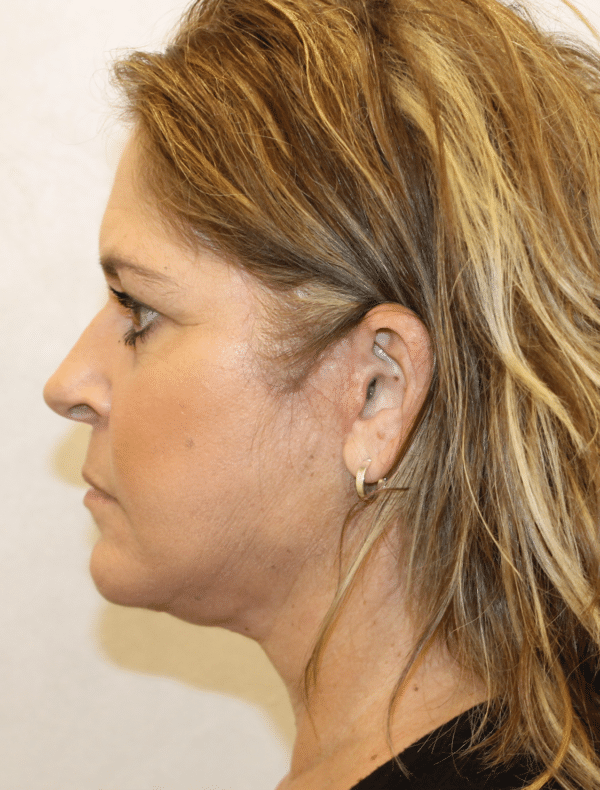 Facelift