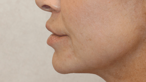 Face Procedures
