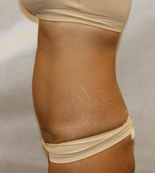 Body Procedures