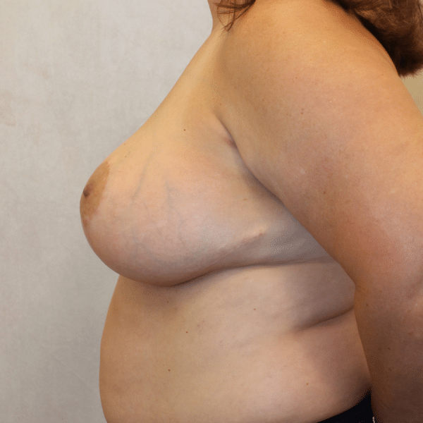 Breast Lift with Implants