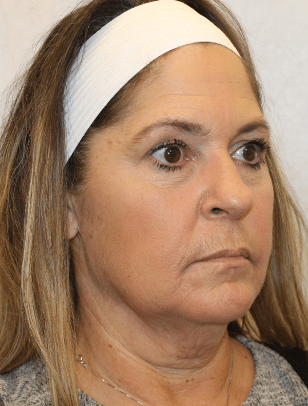 Facelift
